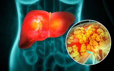 Một thói quen ăn uống quen thuộc có thể làm tăng nguy cơ ung thư gan, người Việt nên tránh