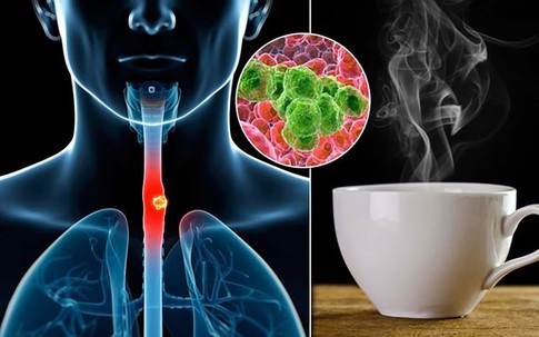 Loại nước uống theo cách 'nuôi tế bào ung thư', người Việt vẫn 'thưởng thức' mỗi ngày mà không biết