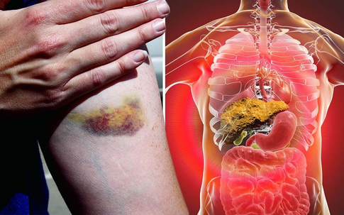 Sau Tết, đây là nhóm người có nguy cơ cao gan nhiễm độc mà không biết, cần đặc biệt lưu ý