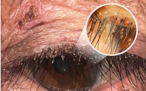 Đi khám vì cộm và ngứa mắt, bất ngờ phát hiện rận mu bám chi chít trên lông mi