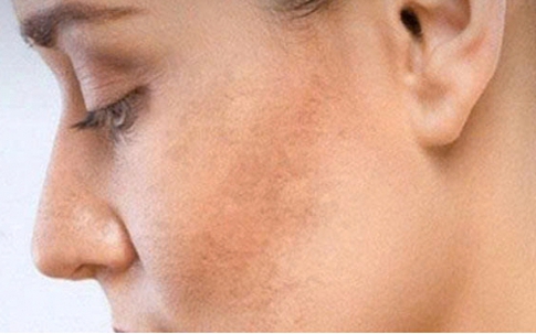 Vì sao da ngày càng sạm màu? Cách lấy lại làn da sáng khỏe