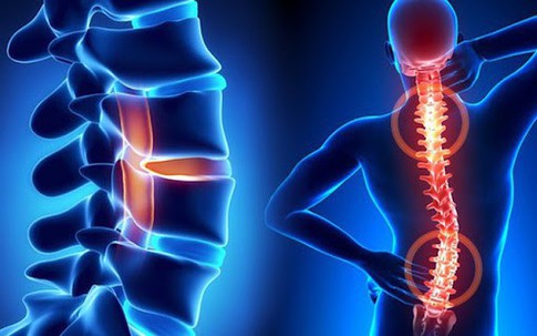 Điểm danh 5 bệnh gây đau cột sống phổ biến hiện nay và cách phòng ngừa