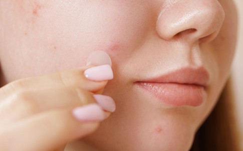 Có nên dùng miếng dán mụn sau khi nặn mụn không?