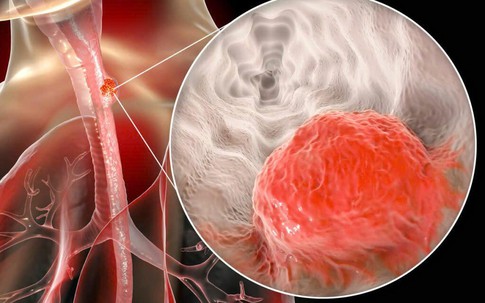 Người đàn ông mắc ung thư thực quản thừa nhận 2 sai lầm nhiều người Việt mắc phải