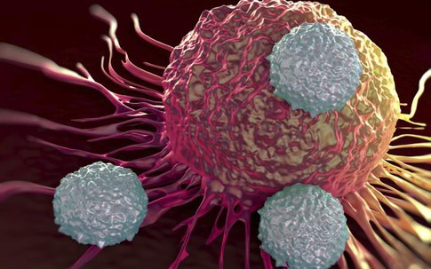 Người phụ nữ 58 tuổi phát hiện ung thư buồng trứng từ dấu hiệu nhiều chị em Việt bỏ qua