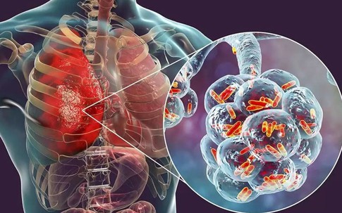 Người đàn ông 60 tuổi phát hiện sớm ung thư phổi hiếm gặp nhờ làm 1 việc mà nhiều người Việt bỏ qua