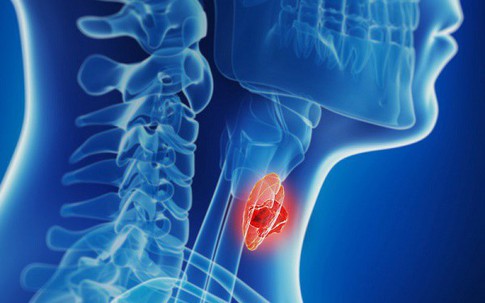 Bé 13 tuổi tình cờ phát hiện ung thư tuyến giáp di căn từ 1 dấu hiệu nhiều người Việt mắc phải