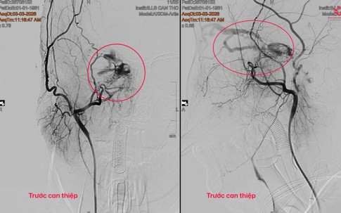 Người phụ nữ 65 tuổi phát hiện dị dạng mạch máu não từ dấu hiệu nhiều người Việt bỏ qua