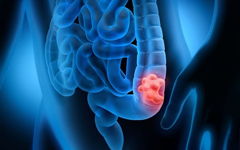 Người phụ nữ 66 tuổi phát hiện ung thư trực tràng từ polyp, thừa nhận 1 sai lầm nhiều người Việt mắc phải