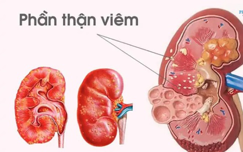 Bé gái 11 tuổi co giật, tăng huyết áp sau viêm họng do biến chứng viêm cầu thận hậu nhiễm liên cầu