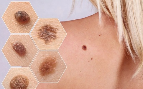 Người phụ nữ phát hiện mắc ung thư hắc tố ở cơ quan sinh dục từ dấu hiệu dễ bị bỏ qua sau mãn kinh