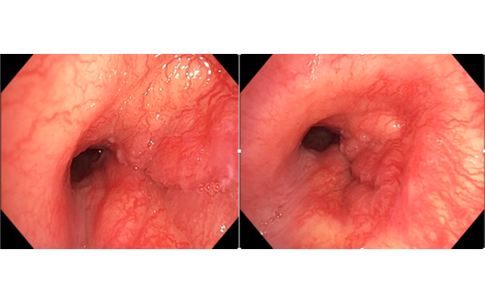 Người đàn ông 32 tuổi phát hiện ung thư phổi hiếm gặp từ dấu hiệu nhiều người Việt mắc phải