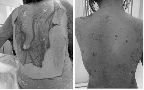 Người phụ nữ 35 tuổi bị tróc da toàn thân thừa nhận 1 sai lầm nhiều người Việt mắc phải