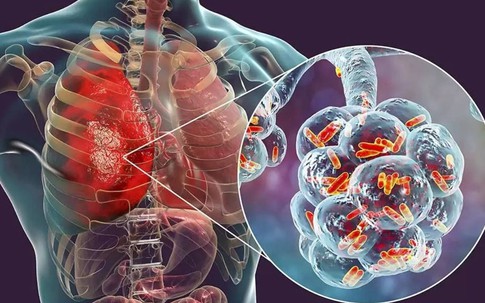 Người đàn ông 67 tuổi ở Hà Nội phát hiện ung thư phổi di căn từ dấu hiệu nhiều người Việt bỏ qua