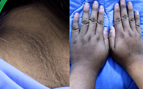 Cô gái 20 tuổi nhập viện vì biến chứng đái tháo đường chỉ từ dấu hiệu tưởng da “bẩn”