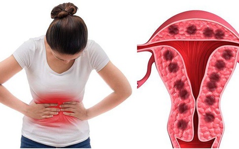 Mắc đái tháo đường, người phụ nữ 45 tuổi suýt gặp biến chứng nặng vì bệnh phụ khoa kéo dài