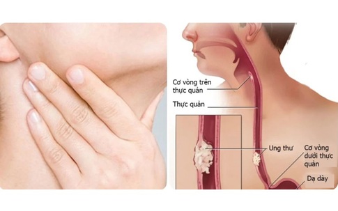 Người đàn ông phát hiện mắc ung thư thực quản thừa nhận 2 sai lầm nhiều người Việt mắc phải