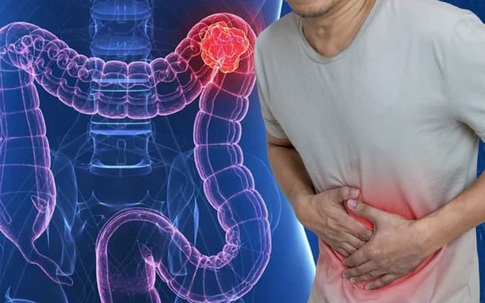 Người đàn ông 45 tuổi phát hiện ung thư đại tràng di căn gan và xương từ dấu hiệu nhiều người Việt mắc phải