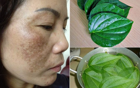Mách bạn 4 cách trị nám lâu năm từ thiên nhiên, rẻ tiền nhưng cực nhạy