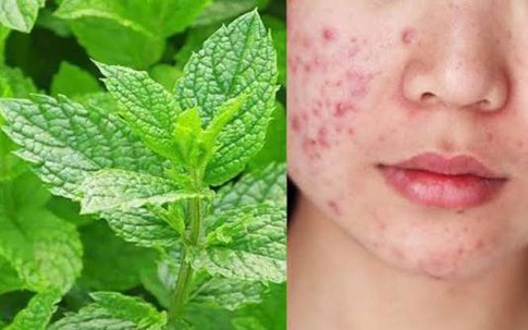 Da mụn nên ăn rau gì cho mát? Mẹo làm đẹp da đơn giản từ các loại rau quen thuộc