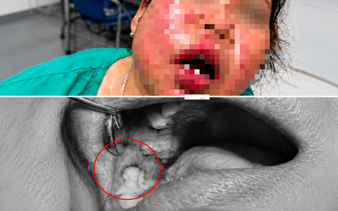 Từ đau răng đến áp xe vùng mặt: Cảnh báo nguy cơ nhiễm trùng ở người đái tháo đường
