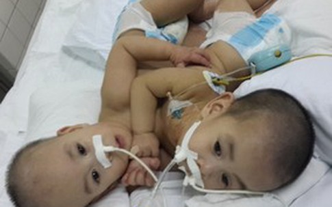 Sức khỏe hai bé được phẫu thuật tách rời đang dần ổn định
