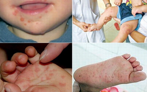 10 bệnh dịch gây tử vong nhiều nhất tại Việt Nam 