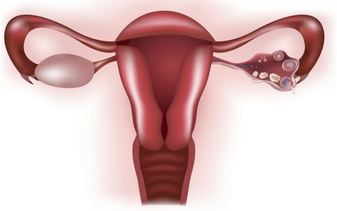 Nguyên nhân khiến buồng trứng bị lão hóa sớm