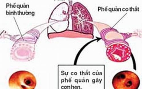 Tại sao Y học cổ truyền điều trị hiệu quả hen mãn tính?