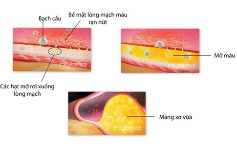 Nguyên nhân số 1 gây tử vong và tàn tật do huyết áp cao