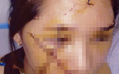 Trẻ 13 tuổi bị bạn rạch mặt vì… ghen