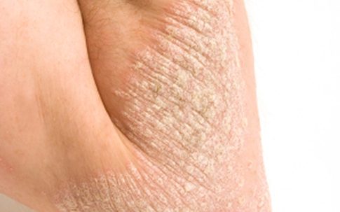 Cẩn trọng với những yếu tố gây bệnh vẩy nến