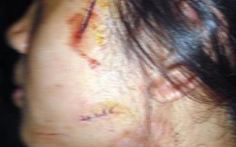 Rạch mặt vợ vì nghi bị 'cắm sừng'