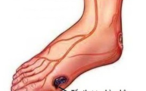 Chủ quan với biến chứng tiểu đường có thể gây đoạn chi