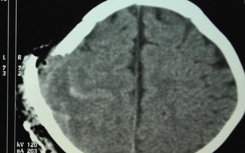 Bố chơi trò tung hứng, bé bị quạt trần chém vào đầu