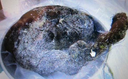 Kinh hãi búi tóc 200g trong dạ dày bé gái 5 tuổi