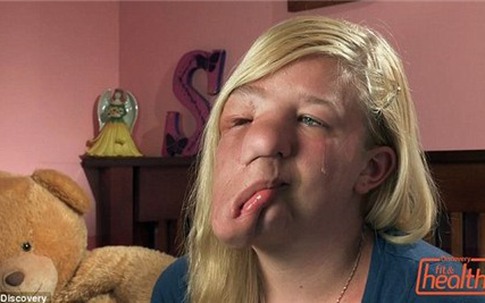 Cô gái trẻ có khuôn mặt "chảy" vì khối u lớn