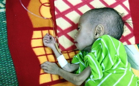 3 tuổi chỉ nặng 6kg, bị suy dinh dưỡng đến teo đét