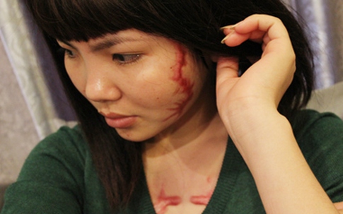 Cô gái bị xăm quái vật vào mặt và ngực nhận 400 triệu bồi thường