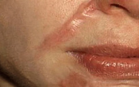 Thực hư vụ nữ sinh "bị rạch mặt"