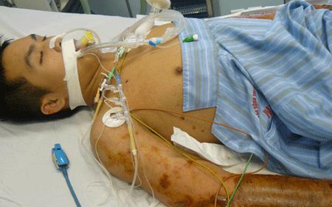 Hơn chục ca bệnh nhập viện vì vi khuẩn “ăn thịt người”