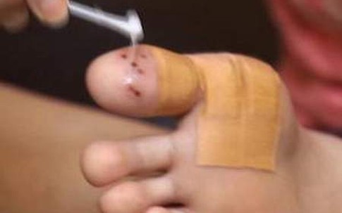 Mắc bệnh tình dục vì .... đi chân đất