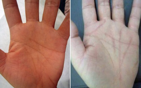 Phẫu thuật đường chỉ tay để đổi vận mệnh