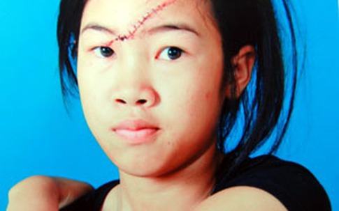 Nữ sinh lớp 8 bị rạch mặt hội đồng