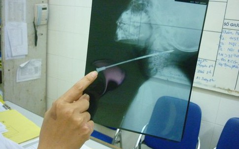 Bé 5 tuổi ngã bị kim đâm xuyên cổ