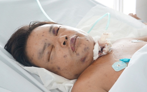 Bắt ong kiếm tiền mua sách cho con, bị ong đốt nguy kịch