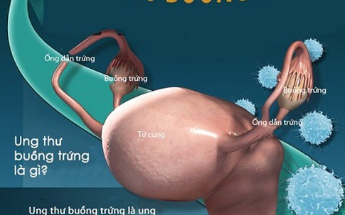 Ung thư buồng trứng – Kẻ giết người thầm lặng