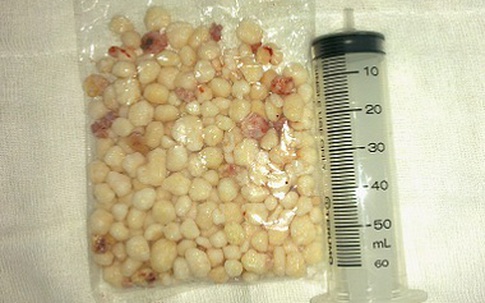 Gặp vị bác sĩ đã gắp 300 hạt sỏi khỏi khớp vai một bệnh nhân