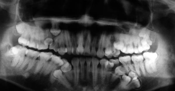 Tổng số răng 3 hàm của con người và vai trò của chúng