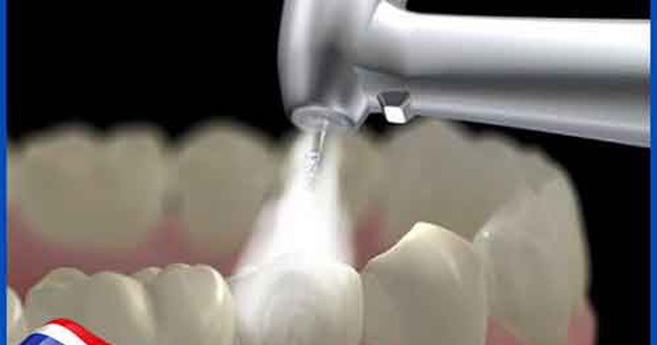 Có những nguy cơ liên quan đến việc trám răng sâu lỗ nhỏ không đúng cách?
